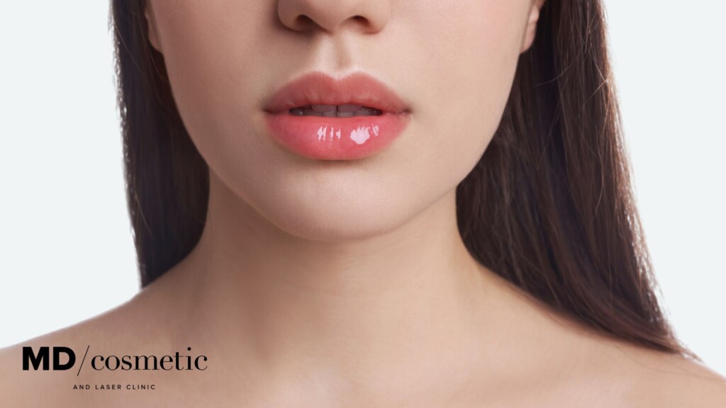 subtle lip fillers